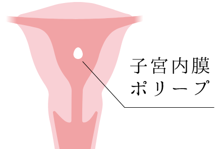 子宮内膜 ポリープ