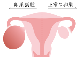 卵巣嚢腫と正常な卵巣